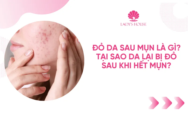 Sản phẩm do da sau mun la gi tai sao da lai bi do sau khi het mun — Công Ty TNHH Ladys House — MST 3702504003