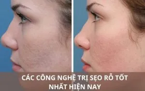 Sản phẩm cong nghe tri seo ro 10 300x188 — Công Ty TNHH MTV Thẩm Mỹ Viện ULA — MST 3702598386