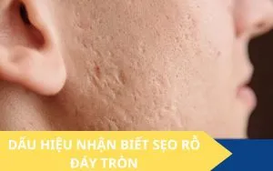 Sản phẩm seo ro day tron 300x188 — Công Ty TNHH MTV Thẩm Mỹ Viện ULA — MST 3702598386