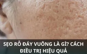 Sản phẩm seo ro day vuong 2 300x188 — Công Ty TNHH MTV Thẩm Mỹ Viện ULA — MST 3702598386