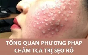 Sản phẩm tca tri seo ro 3 300x188 — Công Ty TNHH MTV Thẩm Mỹ Viện ULA — MST 3702598386