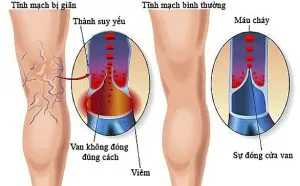 Sản phẩm khach_phuc_suy_gian_tinh_mach_bang_cach_don_gian 300x186 — Công Ty TNHH Kỹ Thuật Thiết Bị Thẩm Mỹ Y Khoa Thiện Phúc — MST 3702828368
