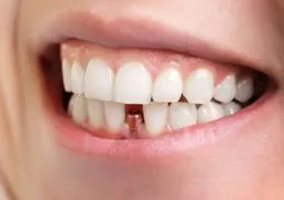 Sản phẩm dich vu cay ghep implant — Nha Khoa Quốc Tế Daisy - Công Ty CP Đầu Tư Diva Holdings — MST 3702941839