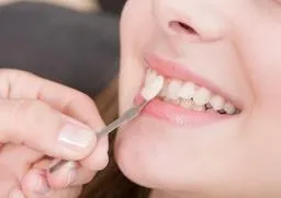Sản phẩm dich vu dan su veneer — Nha Khoa Quốc Tế Daisy - Công Ty CP Đầu Tư Diva Holdings — MST 3702941839
