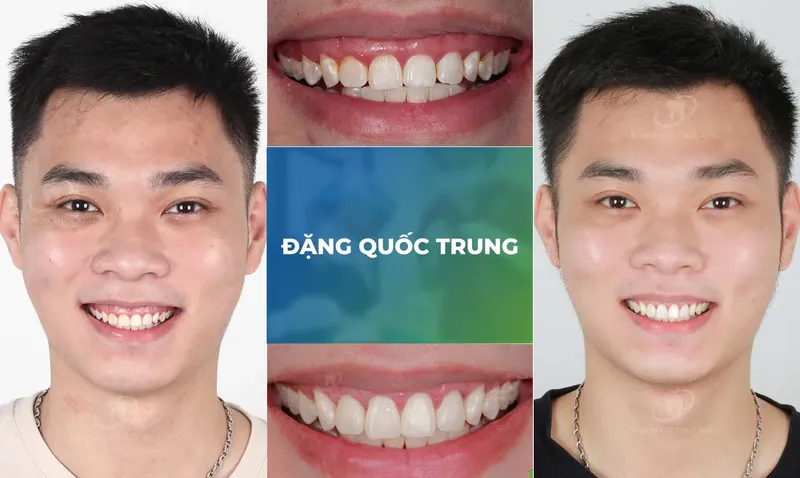 Sản phẩm ho loi trang chu m — Nha Khoa Thùy Anh — MST 4601323323