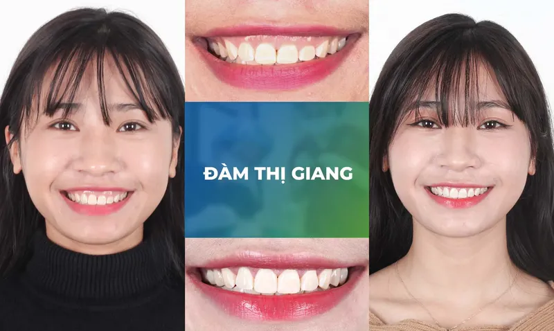 Sản phẩm ho loi trang chu m1 — Nha Khoa Thùy Anh — MST 4601323323