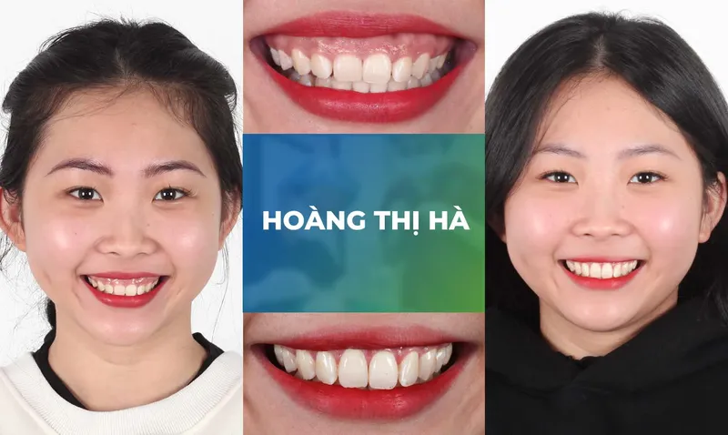 Sản phẩm ho loi trang chu m2 — Nha Khoa Thùy Anh — MST 4601323323
