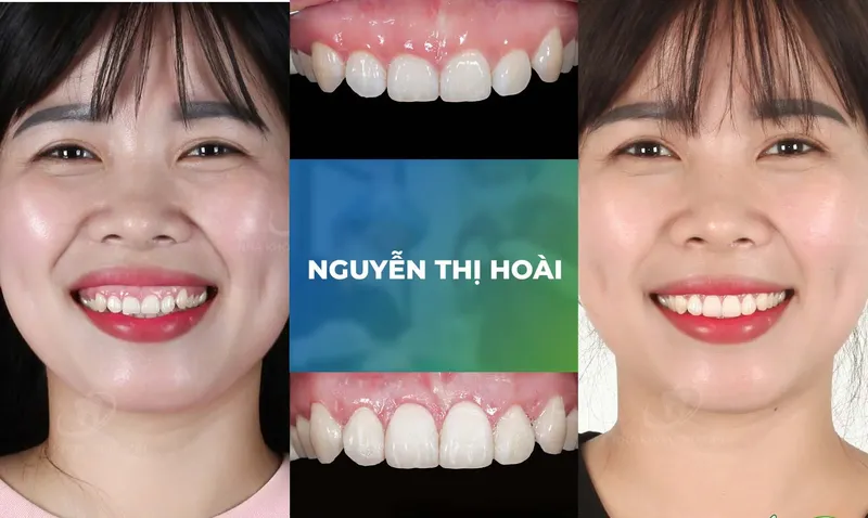 Sản phẩm ho loi trang chu m3 — Nha Khoa Thùy Anh — MST 4601323323