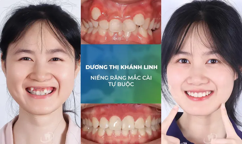 Sản phẩm nieng rang trang chu m — Nha Khoa Thùy Anh — MST 4601323323