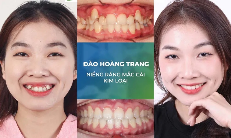 Sản phẩm nieng rang trang chu m1 — Nha Khoa Thùy Anh — MST 4601323323