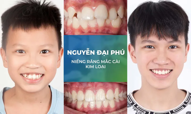 Sản phẩm nieng rang trang chu m2 — Nha Khoa Thùy Anh — MST 4601323323