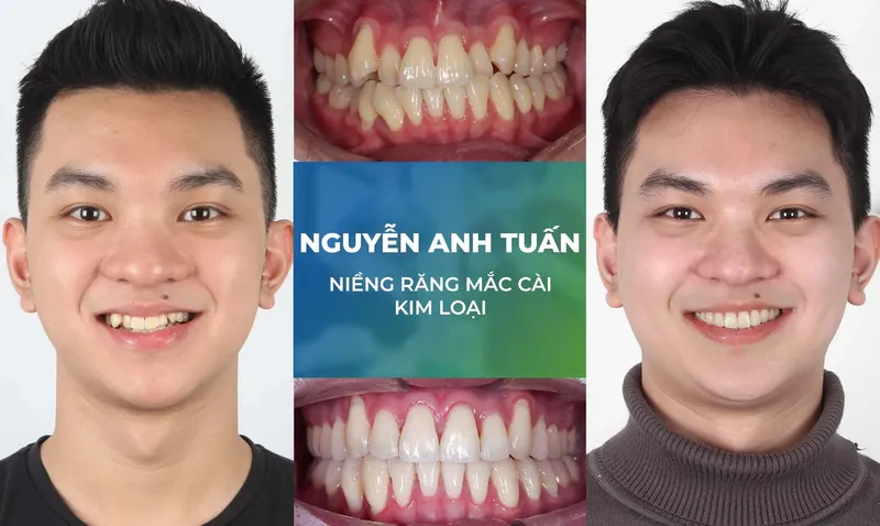 Sản phẩm nieng rang trang chu m3 — Nha Khoa Thùy Anh — MST 4601323323