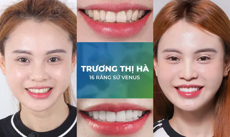 Sản phẩm rang su trang chu m — Nha Khoa Thùy Anh — MST 4601323323