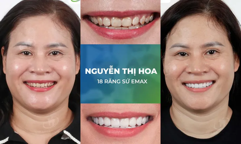 Sản phẩm rang su trang chu m1 — Nha Khoa Thùy Anh — MST 4601323323