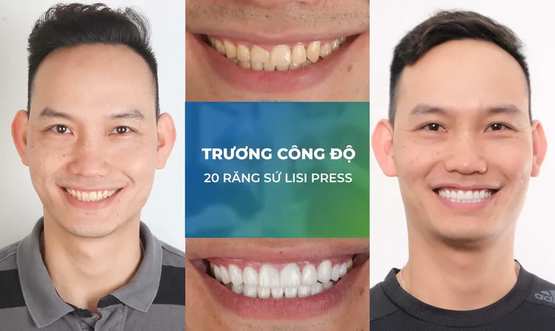 Sản phẩm rang su trang chu m2 — Nha Khoa Thùy Anh — MST 4601323323