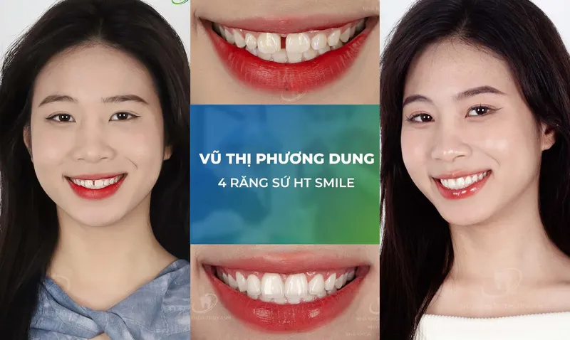 Sản phẩm rang su trang chu m3 — Nha Khoa Thùy Anh — MST 4601323323