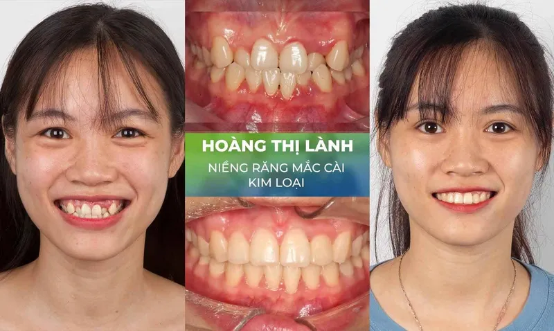 Sản phẩm nieng rang trang chu 1 — Nha Khoa Thùy Anh — MST 4601323323