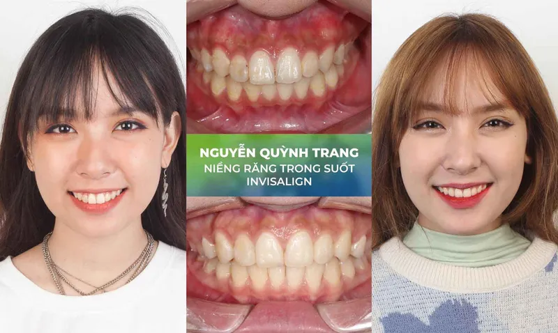 Sản phẩm nieng rang trang chu 2 — Nha Khoa Thùy Anh — MST 4601323323