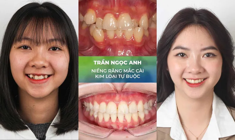 Sản phẩm nieng rang trang chu 3 — Nha Khoa Thùy Anh — MST 4601323323