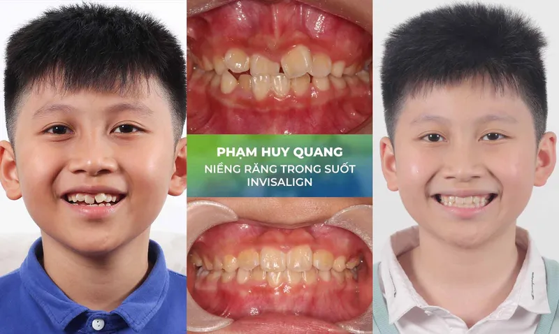 Sản phẩm nieng rang trang chu 4 — Nha Khoa Thùy Anh — MST 4601323323