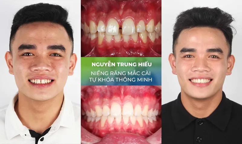 Sản phẩm nieng rang trang chu 5 — Nha Khoa Thùy Anh — MST 4601323323