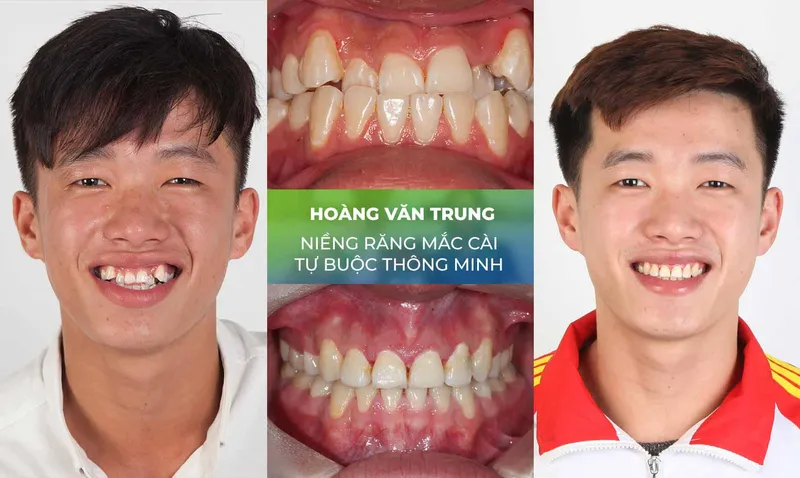 Sản phẩm nieng rang trang chu 6 — Nha Khoa Thùy Anh — MST 4601323323