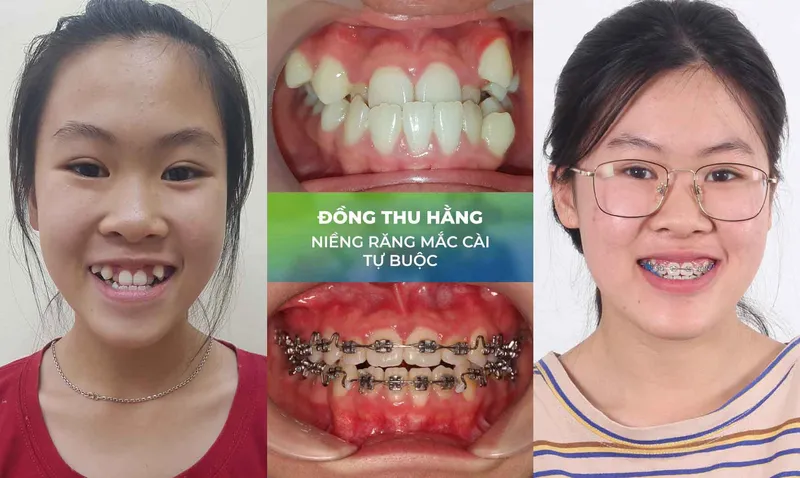 Sản phẩm nieng rang trang chu 7 — Nha Khoa Thùy Anh — MST 4601323323
