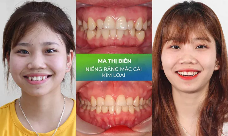 Sản phẩm nieng rang trang chu 8 — Nha Khoa Thùy Anh — MST 4601323323