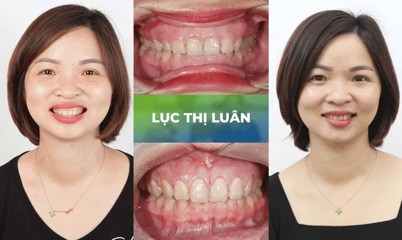 Sản phẩm trang chu cuoi ho loi 1 — Nha Khoa Thùy Anh — MST 4601323323