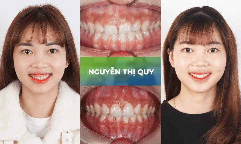 Sản phẩm trang chu cuoi ho loi 2 — Nha Khoa Thùy Anh — MST 4601323323