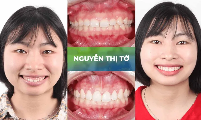 Sản phẩm trang chu cuoi ho loi 3 — Nha Khoa Thùy Anh — MST 4601323323