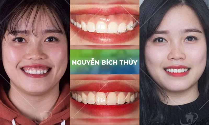 Sản phẩm trang chu cuoi ho loi 4 — Nha Khoa Thùy Anh — MST 4601323323