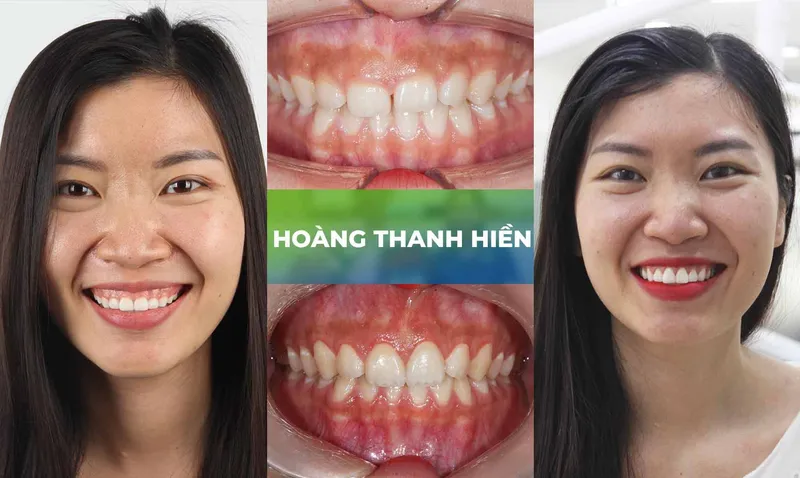 Sản phẩm trang chu cuoi ho loi 5 — Nha Khoa Thùy Anh — MST 4601323323