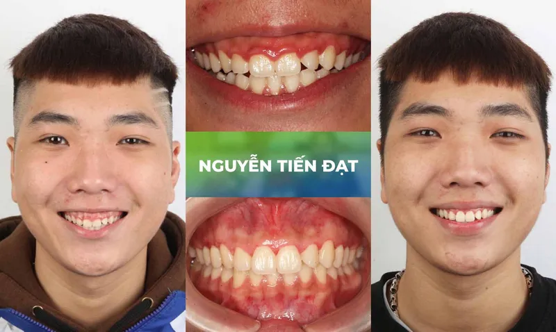 Sản phẩm trang chu cuoi ho loi 6 — Nha Khoa Thùy Anh — MST 4601323323