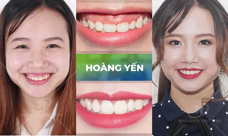 Sản phẩm trang chu cuoi ho loi 7 — Nha Khoa Thùy Anh — MST 4601323323