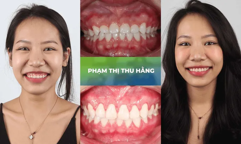 Sản phẩm trang chu cuoi ho loi — Nha Khoa Thùy Anh — MST 4601323323