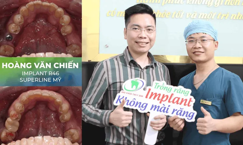 Sản phẩm trang chu implant 1 — Nha Khoa Thùy Anh — MST 4601323323